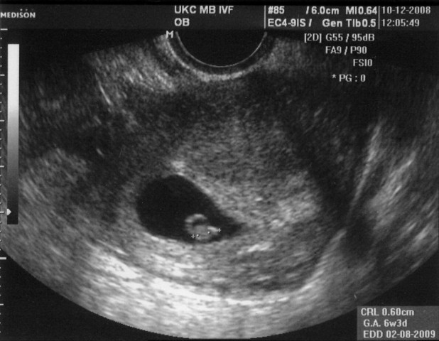 Prvi ultrazvok v 7 tednu