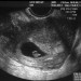 prvi ultrazvok v 7 tednu